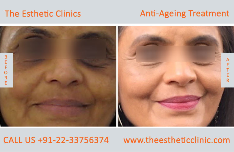 Anti Aging Treatment for Face Wrinkles before after photos in mumbai india (1 (3)